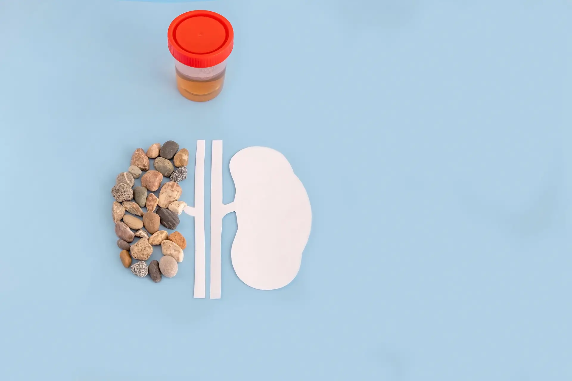 Illustration of kidney stones affecting kidney function